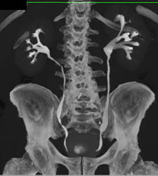what is a urogram ct scan