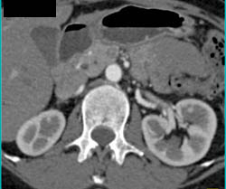 Fibromuscular Dysplasia (FMD) - Seen Only in 3D - CTisus CT Scan