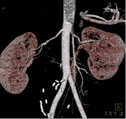 Fibromuscular Dysplasia (FMD) Renal Arteries and Retroaortic Left Renal Vein - CTisus CT Scan