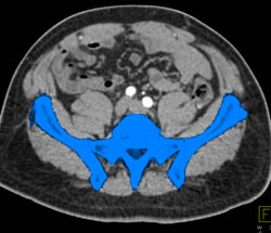 Automatic Bone Editing Sequence for Vascular Mapping - CTisus CT Scan