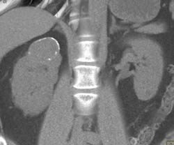 Calcified Renal Mass - CTisus CT Scan