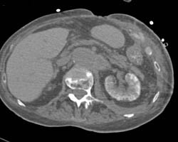 Contrast-induced nephropathy (CIN) - acute Renal Failure - CTisus CT Scan