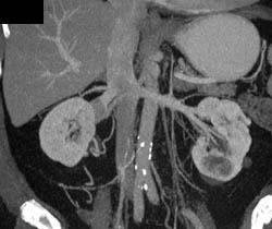 Right Renal Cell Carcinoma With Renal Vein Involvement - CTisus CT Scan