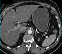 Small Renal and Splenic Artery Aneurysms - CTisus CT Scan