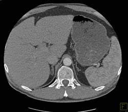 Dual Energy Kidney- Normal - CTisus CT Scan