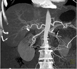 Fibromuscular Dysplasia (FMD) Left and Right Renal Artery - CTisus CT Scan