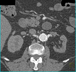 Renal Artery Stent That Is Stenotic - CTisus CT Scan