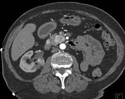 Recurrent Renal Cell Carcinoma With Nodes and Renal Mass Contralateral Kidney - CTisus CT Scan