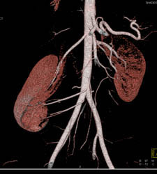 3 Right Renal Artery Including Off Iliac Artery - CTisus CT Scan