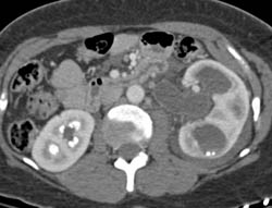 Left Hydronephrosis With Bleed in Left Renal Pelvis - CTisus CT Scan