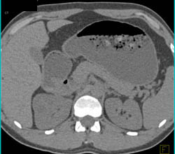 Clear Cell Renal Cell Carcinoma- See Sequence - CTisus CT Scan