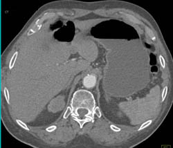 Subtle Renal Cell Carcinoma Upper Pole Right Kidney - CTisus CT Scan