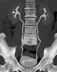 Normal CT Urogram - CTisus CT Scan