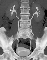 Normal CT Urogram - Kidney Case Studies - CTisus CT Scanning