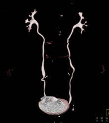 Normal CT Urogram - CTisus CT Scan