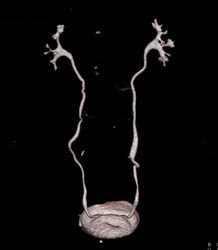 Normal CT Urogram - CTisus CT Scan