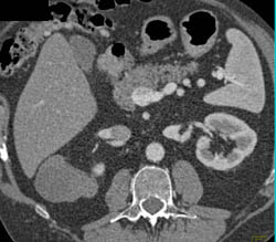 Cystic Renal Cell Carcinoma - CTisus CT Scan