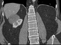 Cystic Renal Cell Carcinoma - CTisus CT Scan