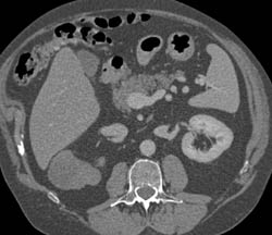 Cystic Renal Cell Carcinoma - CTisus CT Scan