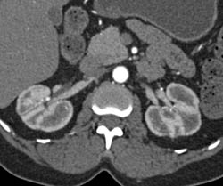 Chronic Pyelonephritis With Papillary Necrosis - CTisus CT Scan