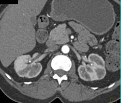 Renal Scarring and Papillary Necrosis - CTisus CT Scan