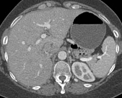 Recurrent Renal Cell Carcinoma Involves IVC and Renal Bed - CTisus CT Scan