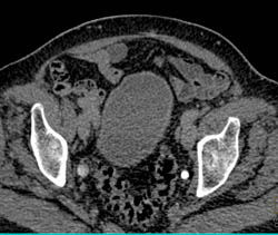 Dilated Veins and Hydronephrosis - CTisus CT Scan