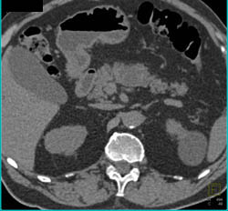 1cm Renal Cell Carcinoma in Right Kidney- See Full Sequence of Images - CTisus CT Scan