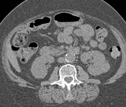 Left Renal Cell Carcinoma - CTisus CT Scan