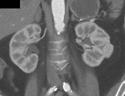 Left Renal Cell Carcinoma - CTisus CT Scan