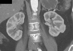 Left Renal Cell Carcinoma - CTisus CT Scan