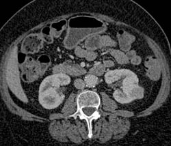 Left Renal Cell Carcinoma - CTisus CT Scan