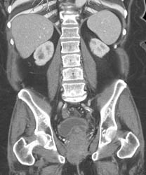 Left Renal Cell Carcinoma - CTisus CT Scan