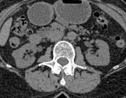 1cm Right Renal Cell Carcinoma- See Full Sequence - CTisus CT Scan