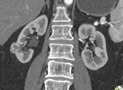 Bilateral Hydronephrosis - CTisus CT Scan