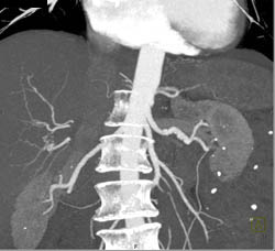 Fibromuscular Dysplasia (FMD) Renal Arteries - CTisus CT Scan