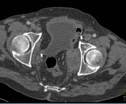 Recurrent Bladder Cancer With Pelvic Adenopathy- Left Pelvic Side Wall - CTisus CT Scan