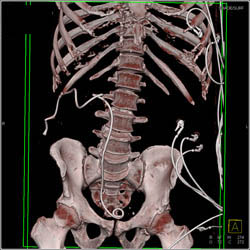 Stent in Right Ureter With Perinephric Stranding - CTisus CT Scan