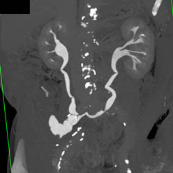 Ileal Loop on CT Urogram - CTisus CT Scan