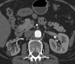 Full Sequence Shows Filling Defect in Upper Pole Calyx on Right. See CT Urogram Images. Transitional Cell Carcinoma of the Kidney. Scarring Right Kidney With Abnormally Blunted Calyces Also. - CTisus CT Scan