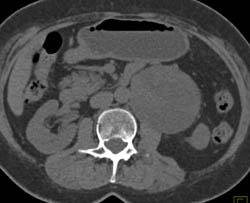 Germ Cell Tumor Displaces the Left Kidney- Full Sequence of Images - CTisus CT Scan