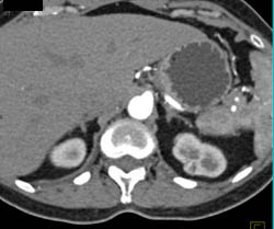 1 Cm Renal Cell Carcinoma- Left Kidney Upper Pole - CTisus CT Scan