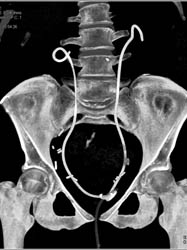 Dilated Calyces With Bilateral Internal Stents - CTisus CT Scan