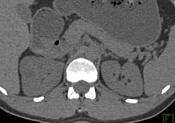 Renal Cell Carcinoma- Full Sequence of Images - CTisus CT Scan