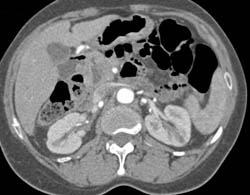 Acute Pyelonephritis of Right and Left Kidney- See Full Sequence of Images - CTisus CT Scan