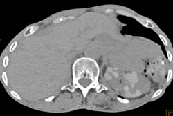 Multiple High Density Renal Cysts in the Left Kidney- See Sequence of Scans - CTisus CT Scan