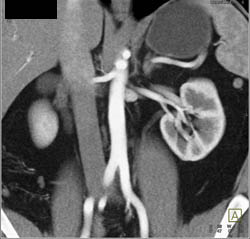 Retroaortic Left Renal Vein - CTisus CT Scan