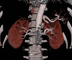 Retroaortic Left Renal Vein - CTisus CT Scan