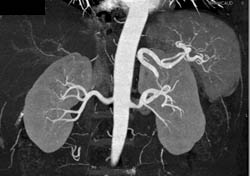 Retroaortic Left Renal Vein - CTisus CT Scan