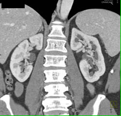 Retroaortic Left Renal Vein - CTisus CT Scan